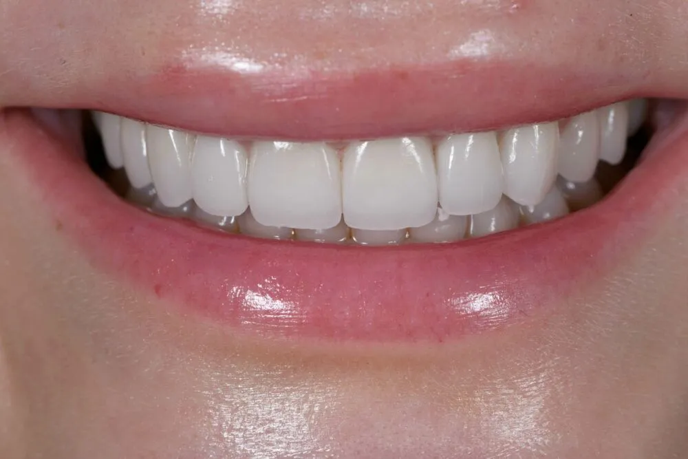 After cosmetic treatment